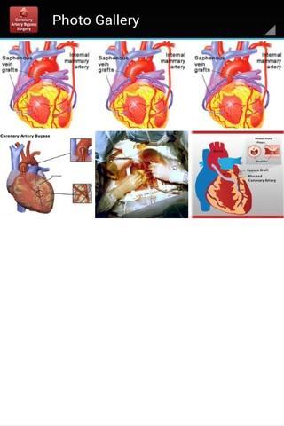 Coronary Artery Bypass - CIMS